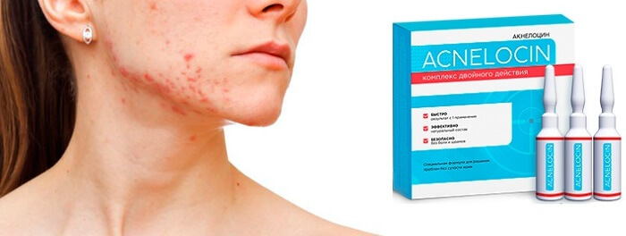 Acnelocin от прыщей: поможет полностью очистить кожу и защитит ее от повторного загрязнения!