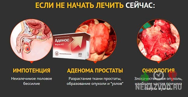Простатит