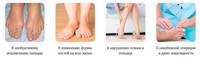 Что происходит с ногами если не лечить вальгусную деформацию