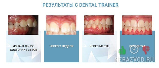Неровные зубы