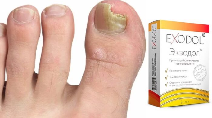 EXODOL от грибка ногтей: к вашим ногам снова вернутся красота и здоровье!