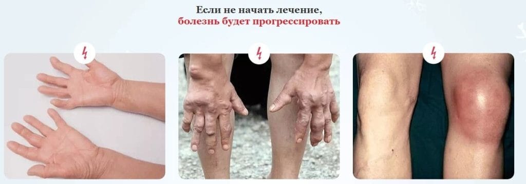 Артекс для суставов - показания к применению