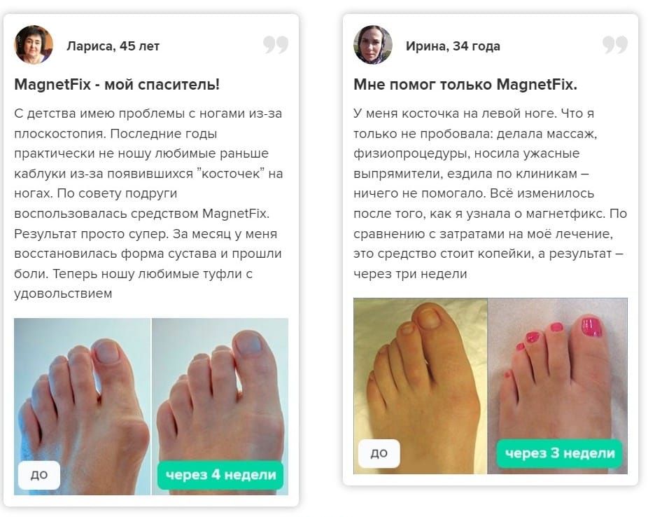 Вальгусная шина MagnetFix отзывы