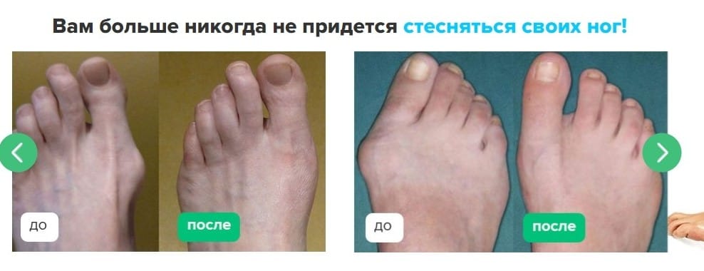 Вальгусная шина MagnetFix до и после