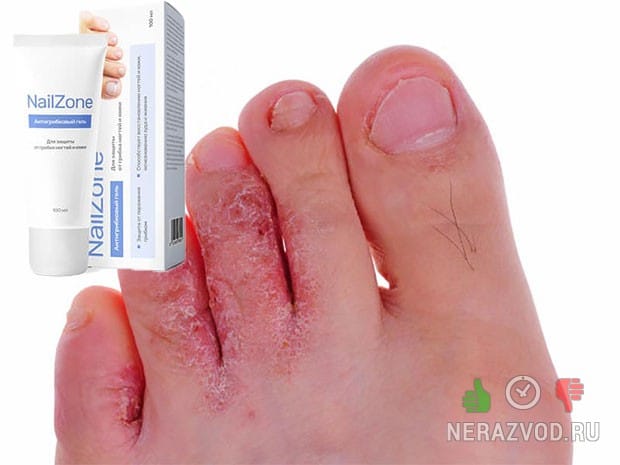 ΠΠ΅Π»Ρ ΠΎΡ Π³ΡΠΈΠ±ΠΊΠ° Nailzone