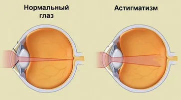 Исключите риск опасных глазных заболеваний