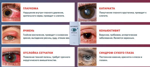 Причины симптома сухого глаза. Синдром сухого глаза симптомы. Степени синдрома сухого глаза. Синдом сухого глаза симптомы.