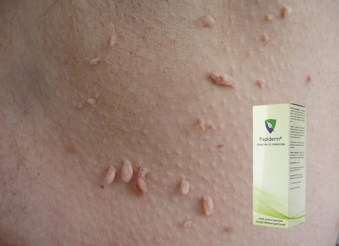 Преимущества средства Papiderm (Папидерм) от папиллом
