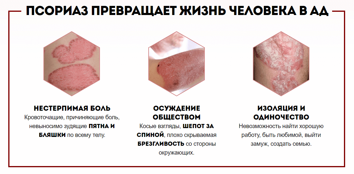 ΠΠΏΡΠΈΠ΄Π΅ΡΠΌΠ°Π» (Optidermal) ΠΎΡ ΠΏΡΠΎΡΠΈΠ°Π·Π° ΠΈΡΠΎΠ³ΠΈ