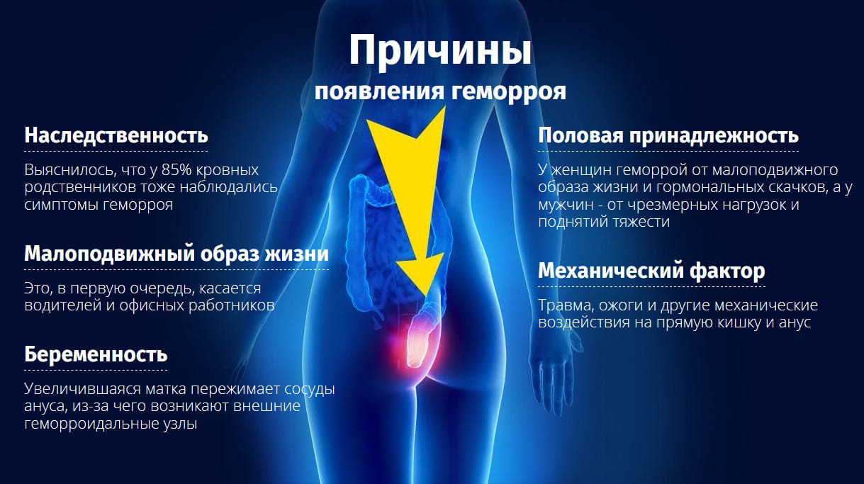 Причина появления геморроя лечение