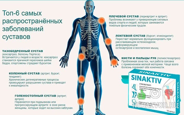 Артриты и артрозы