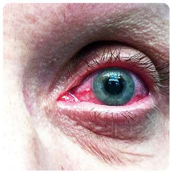 Воспаление глаза до применения препарата VisuTabs.