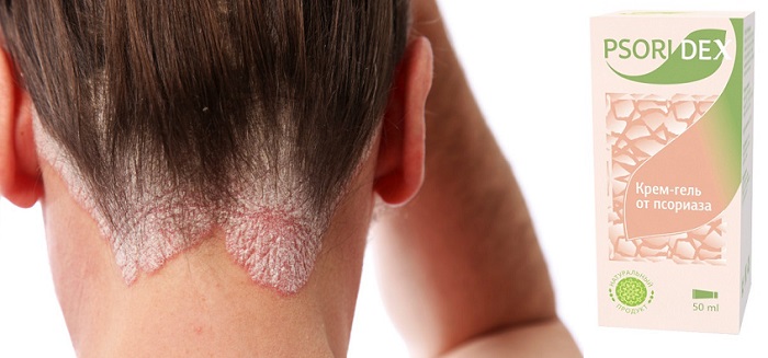 Psoridex от псориаза: лучшее решение для лечения и восстановления кожи!