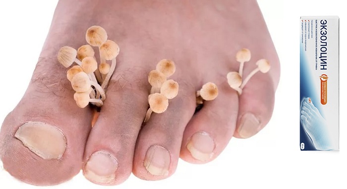 Экзолоцин от грибка ног и ногтей: защитит вас и близких от заражения!